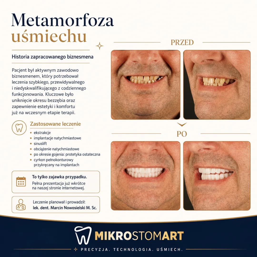Metamorfoza uśmiechu zapracowanego biznesmena — implanty z natychmiastowym obciążeniem